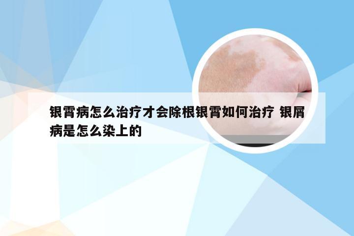 银霄病怎么治疗才会除根银霄如何治疗 银屑病是怎么染上的