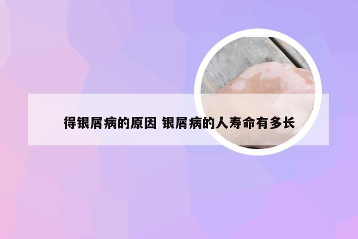 得银屑病的原因 银屑病的人寿命有多长