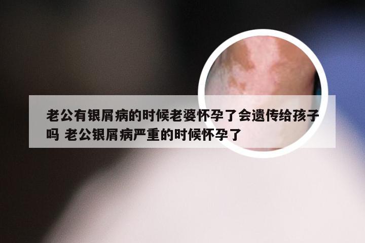 老公有银屑病的时候老婆怀孕了会遗传给孩子吗 老公银屑病严重的时候怀孕了