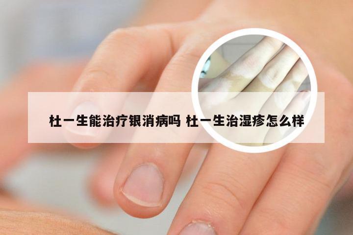 杜一生能治疗银消病吗 杜一生治湿疹怎么样