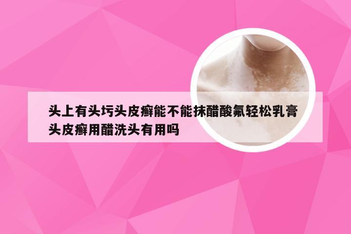 头上有头圬头皮癣能不能抹醋酸氟轻松乳膏 头皮癣用醋洗头有用吗