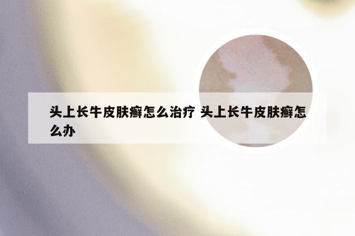 头上长牛皮肤癣怎么治疗 头上长牛皮肤癣怎么办