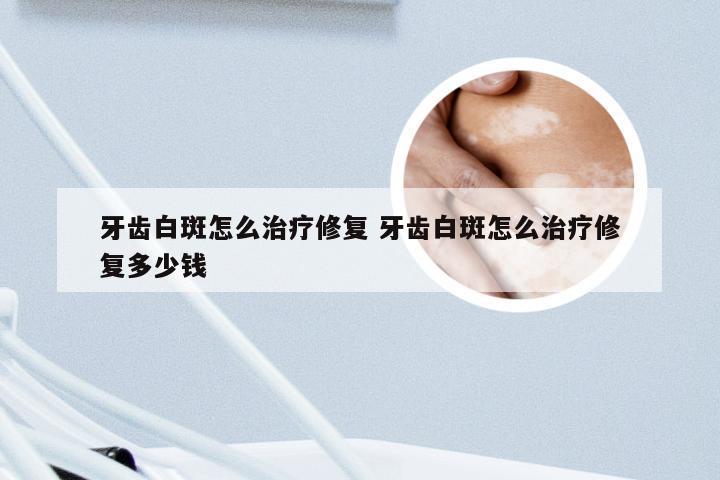 牙齿白斑怎么治疗修复 牙齿白斑怎么治疗修复多少钱