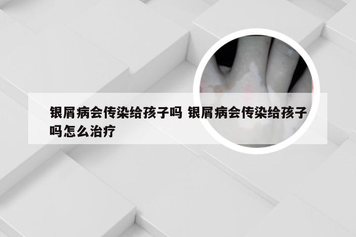 银屑病会传染给孩子吗 银屑病会传染给孩子吗怎么治疗