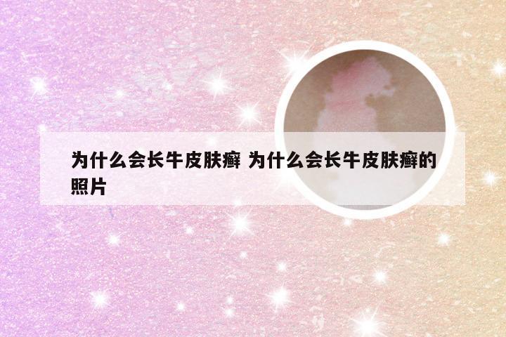 为什么会长牛皮肤癣 为什么会长牛皮肤癣的照片