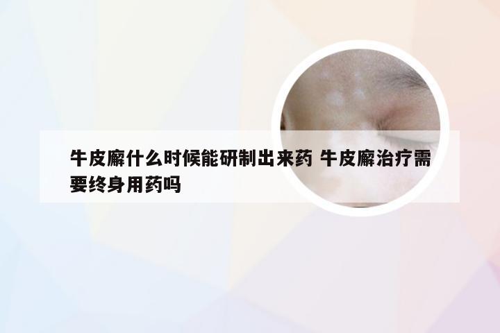 牛皮廨什么时候能研制出来药 牛皮廨治疗需要终身用药吗