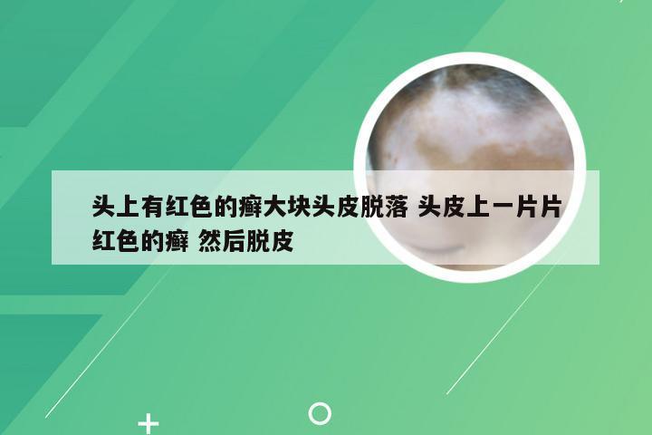 头上有红色的癣大块头皮脱落 头皮上一片片红色的癣 然后脱皮