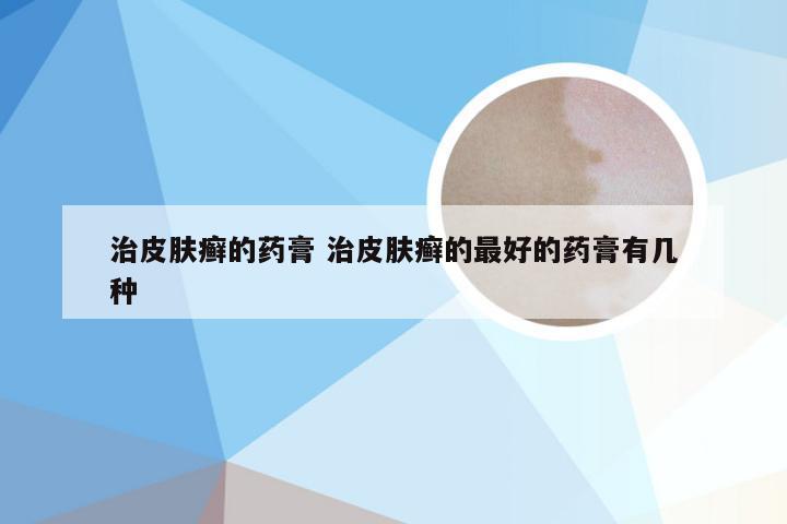 治皮肤癣的药膏 治皮肤癣的最好的药膏有几种
