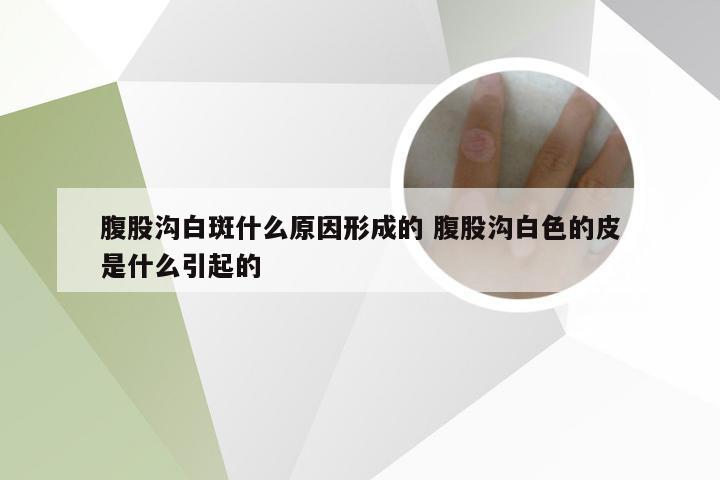 腹股沟白斑什么原因形成的 腹股沟白色的皮是什么引起的