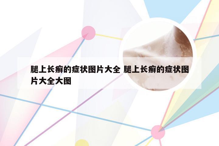 腿上长癣的症状图片大全 腿上长癣的症状图片大全大图