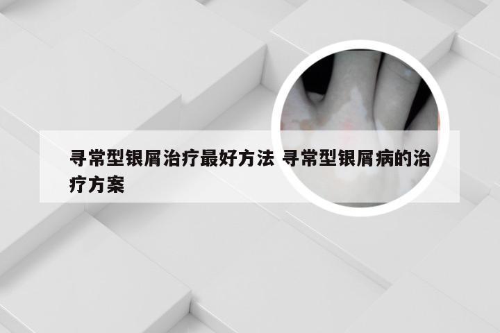 寻常型银屑治疗最好方法 寻常型银屑病的治疗方案