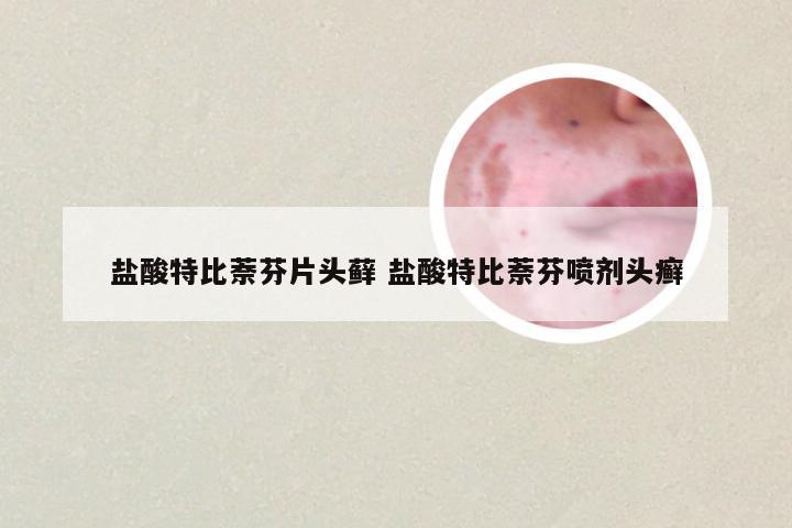盐酸特比萘芬片头藓 盐酸特比萘芬喷剂头癣