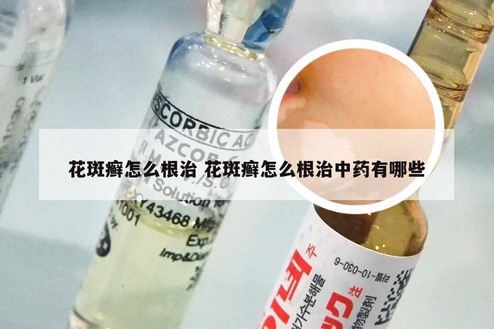 花斑癣怎么根治 花斑癣怎么根治中药有哪些