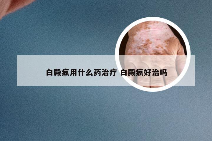 白殿疯用什么药治疗 白殿疯好治吗