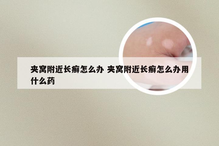 夹窝附近长癣怎么办 夹窝附近长癣怎么办用什么药
