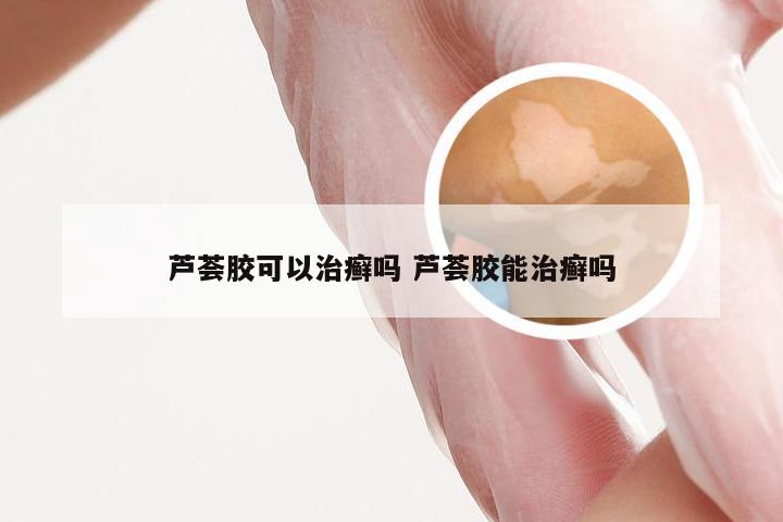 芦荟胶可以治癣吗 芦荟胶能治癣吗