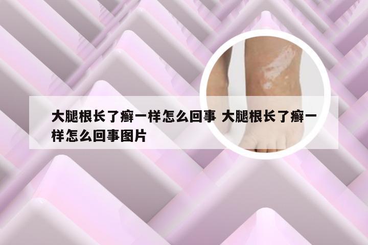 大腿根长了癣一样怎么回事 大腿根长了癣一样怎么回事图片