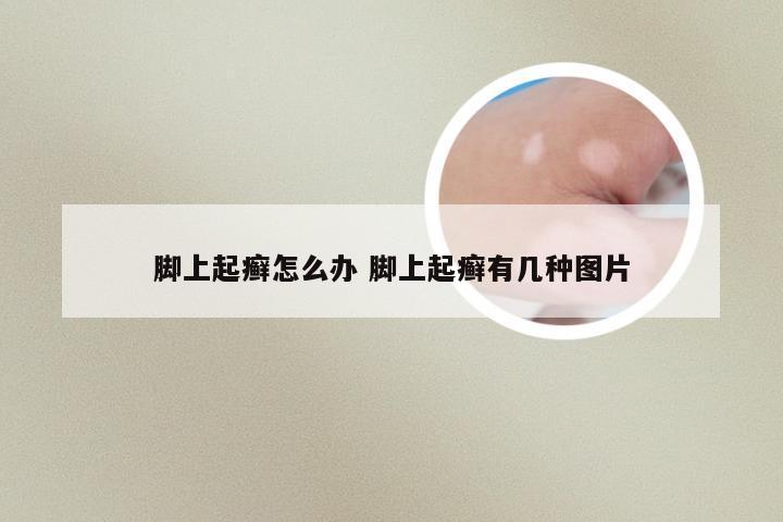 脚上起癣怎么办 脚上起癣有几种图片