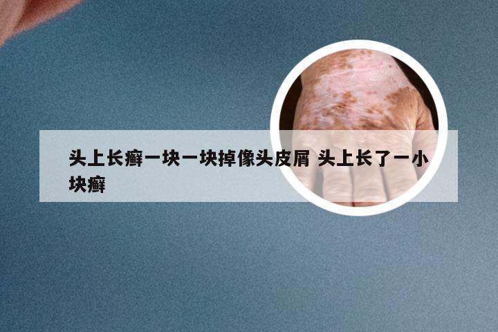 头上长癣一块一块掉像头皮屑 头上长了一小块癣