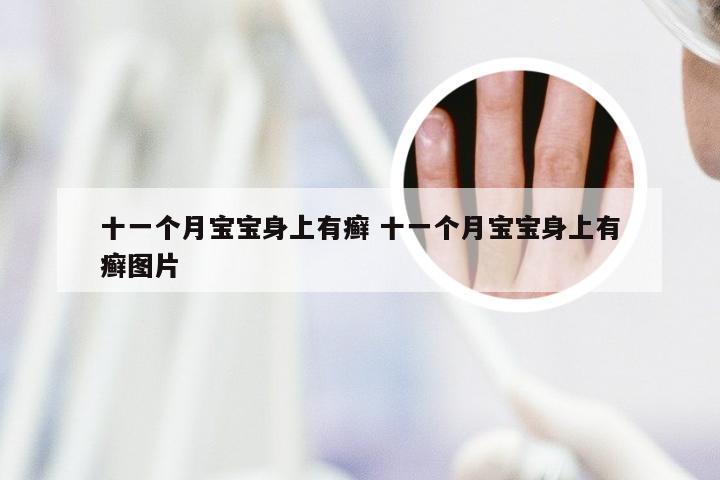 十一个月宝宝身上有癣 十一个月宝宝身上有癣图片