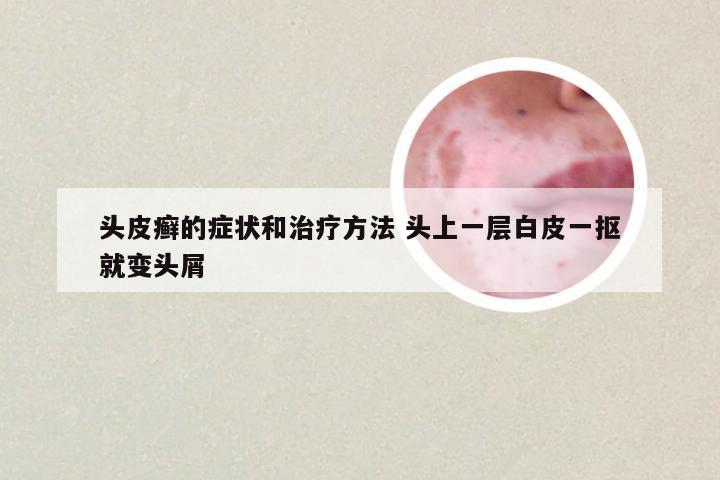 头皮癣的症状和治疗方法 头上一层白皮一抠就变头屑