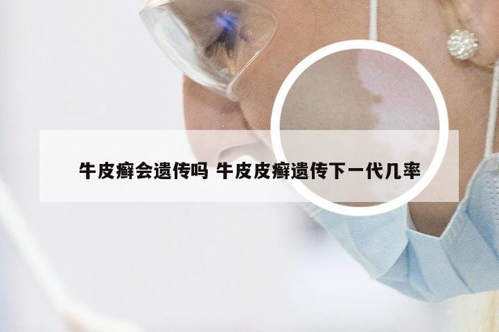 牛皮癣会遗传吗 牛皮皮癣遗传下一代几率