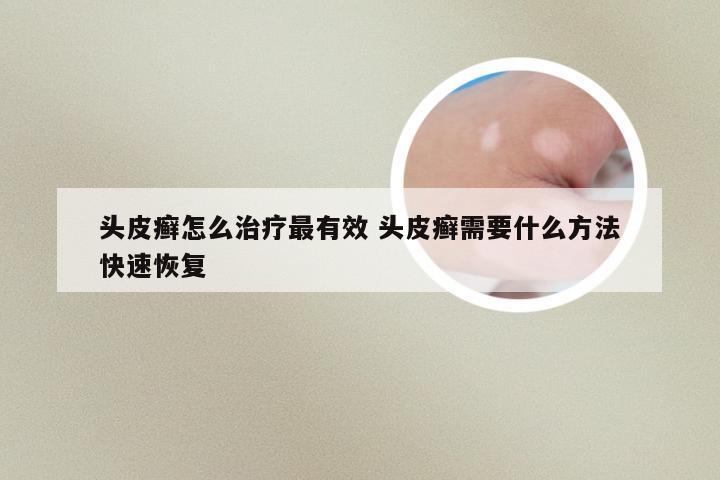 头皮癣怎么治疗最有效 头皮癣需要什么方法快速恢复