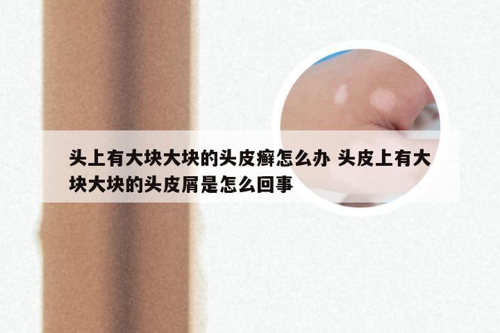 头上有大块大块的头皮癣怎么办 头皮上有大块大块的头皮屑是怎么回事