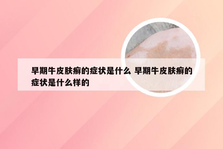 早期牛皮肤癣的症状是什么 早期牛皮肤癣的症状是什么样的