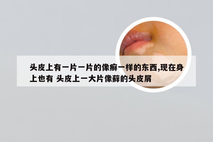 头皮上有一片一片的像癣一样的东西,现在身上也有 头皮上一大片像藓的头皮屑