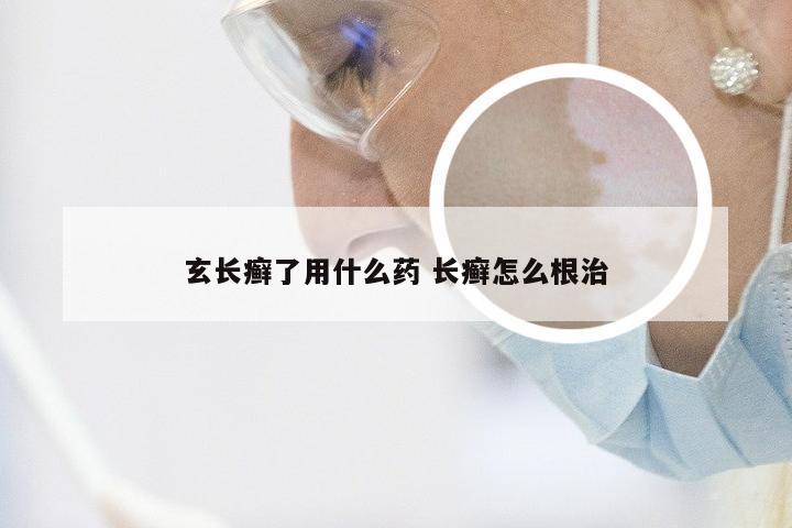 玄长癣了用什么药 长癣怎么根治