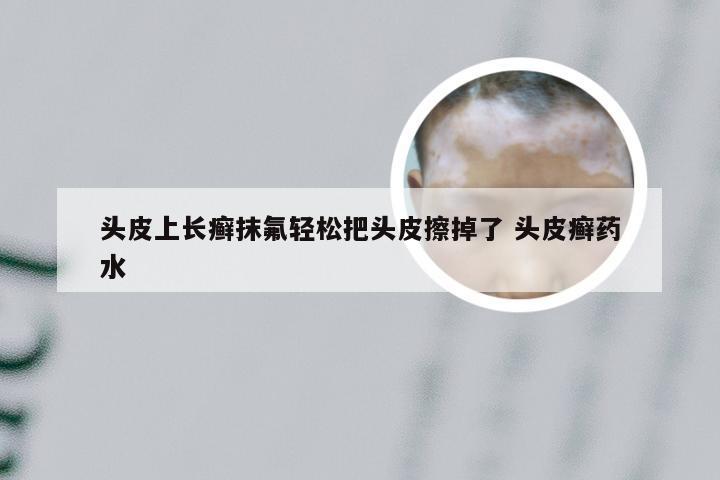 头皮上长癣抹氟轻松把头皮擦掉了 头皮癣药水