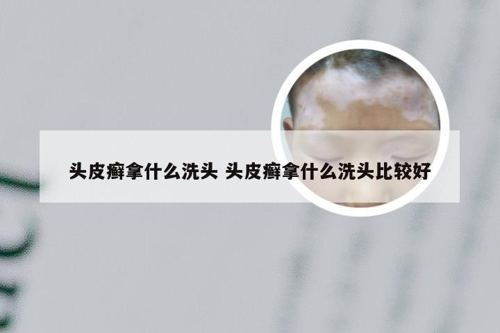 头皮癣拿什么洗头 头皮癣拿什么洗头比较好