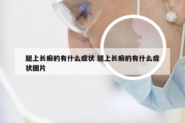 腿上长癣的有什么症状 腿上长癣的有什么症状图片