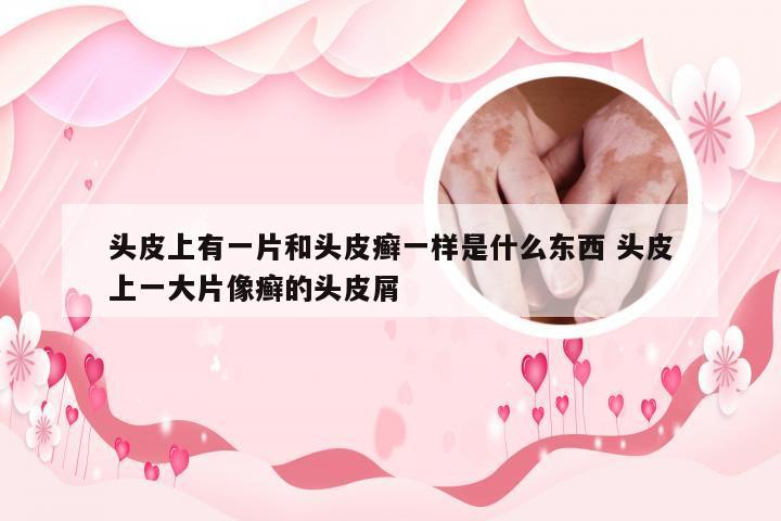 头皮上有一片和头皮癣一样是什么东西 头皮上一大片像癣的头皮屑