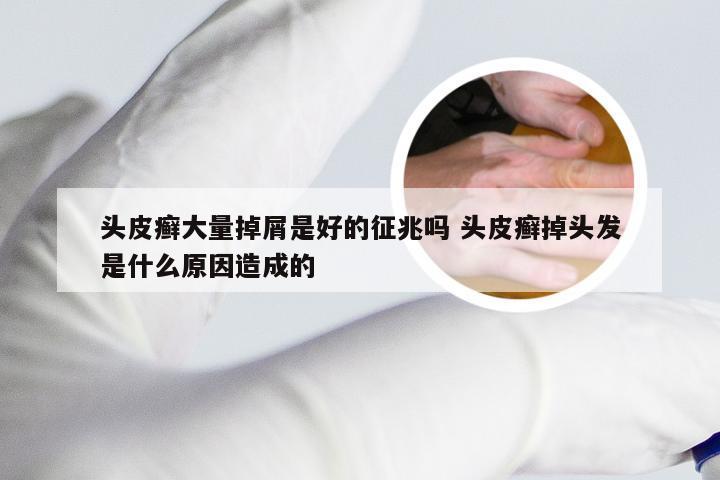 头皮癣大量掉屑是好的征兆吗 头皮癣掉头发是什么原因造成的