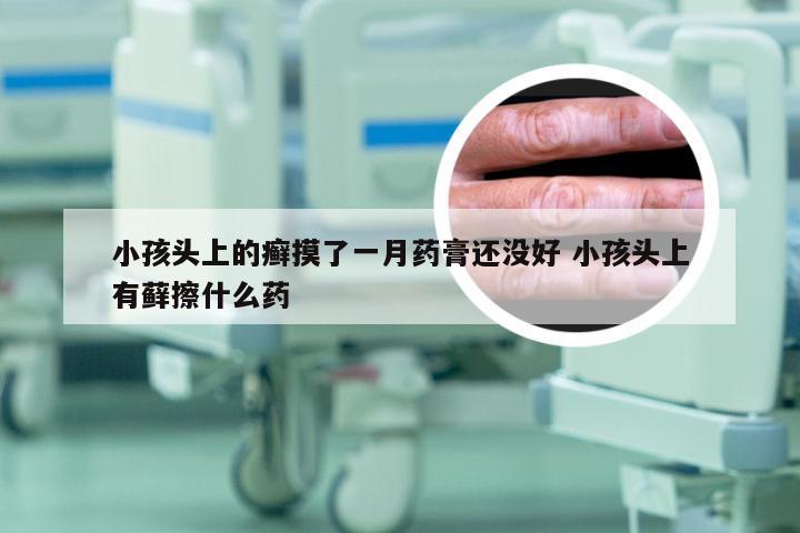 小孩头上的癣摸了一月药膏还没好 小孩头上有藓擦什么药