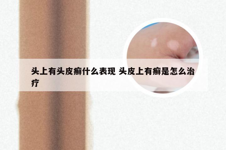 头上有头皮癣什么表现 头皮上有癣是怎么治疗