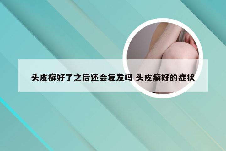 头皮癣好了之后还会复发吗 头皮癣好的症状