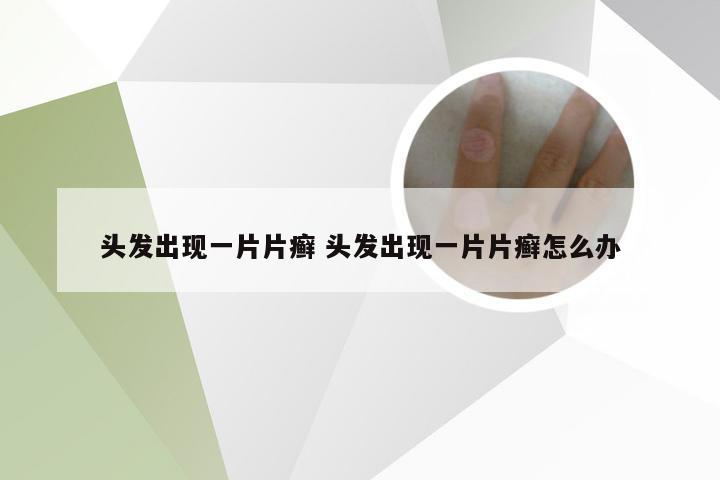 头发出现一片片癣 头发出现一片片癣怎么办