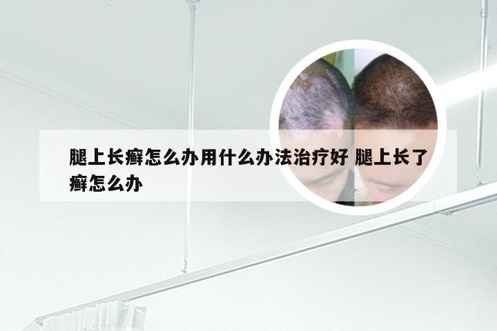 腿上长癣怎么办用什么办法治疗好 腿上长了癣怎么办