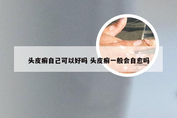 头皮癣自己可以好吗 头皮癣一般会自愈吗