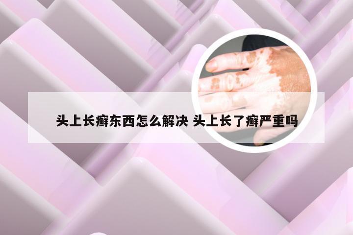 头上长癣东西怎么解决 头上长了癣严重吗