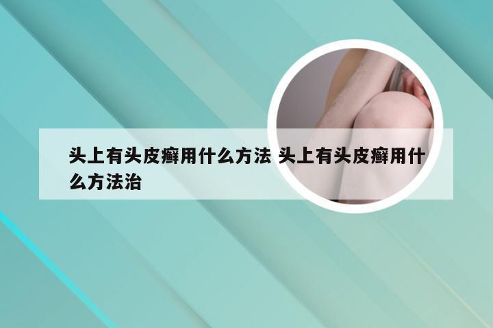 头上有头皮癣用什么方法 头上有头皮癣用什么方法治