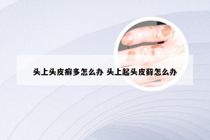 头上头皮癣多怎么办 头上起头皮藓怎么办