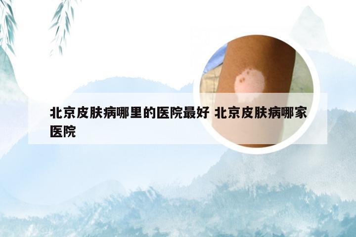 北京皮肤病哪里的医院最好 北京皮肤病哪家医院