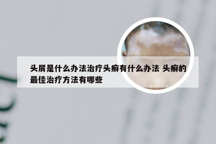 头屑是什么办法治疗头癣有什么办法 头癣的最佳治疗方法有哪些