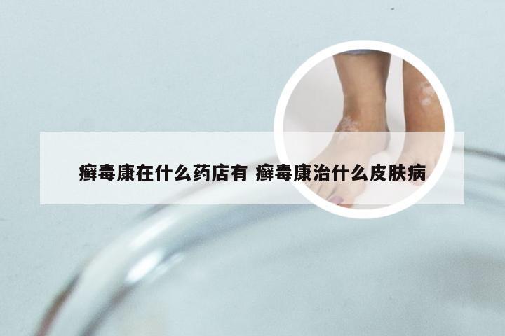 癣毒康在什么药店有 癣毒康治什么皮肤病