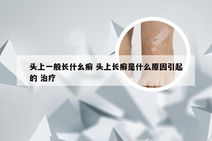头上一般长什幺癣 头上长癣是什么原因引起的 治疗
