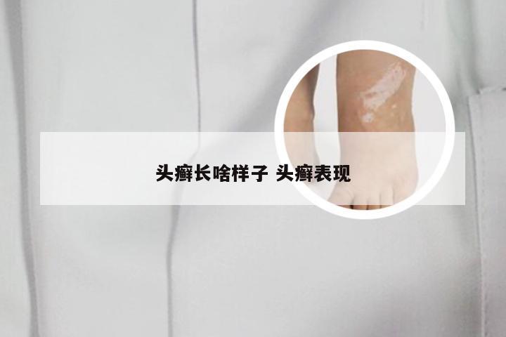 头癣长啥样子 头癣表现